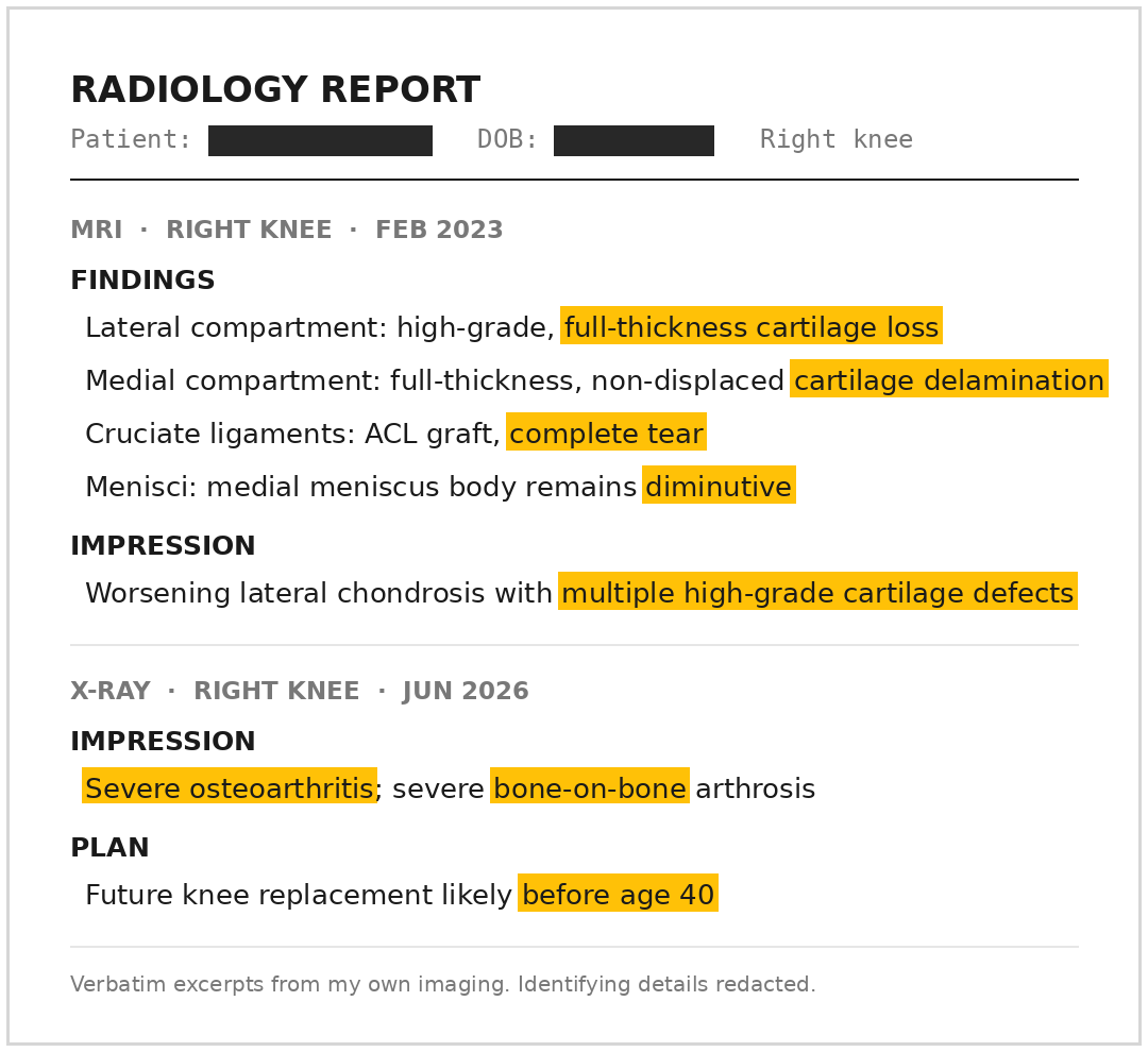 Excerpts from Connor's imaging with findings highlighted: a 2023 MRI listing full-thickness cartilage loss and a complete ACL graft tear, and a 2026 X-ray impression of severe bone-on-bone osteoarthritis with knee replacement likely before age 40. Identifying details redacted.